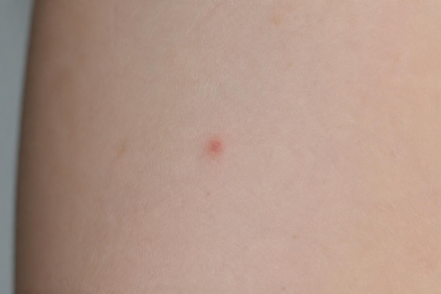 découvrez ce qu'est le bouton araignée, une petite tache rouge sur la peau qui intrigue. comprenez ses causes, son apparence et quand consulter un médecin.
