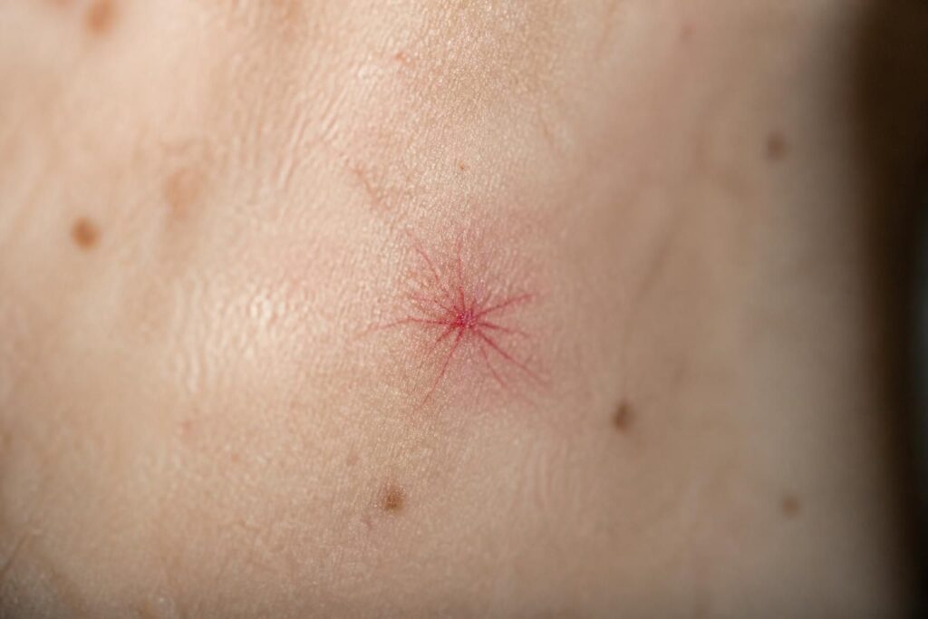 découvrez ce qu'est un bouton araignée, cette petite tache rouge qui intrigue la peau, ses causes, son apparence et comment la traiter efficacement.
