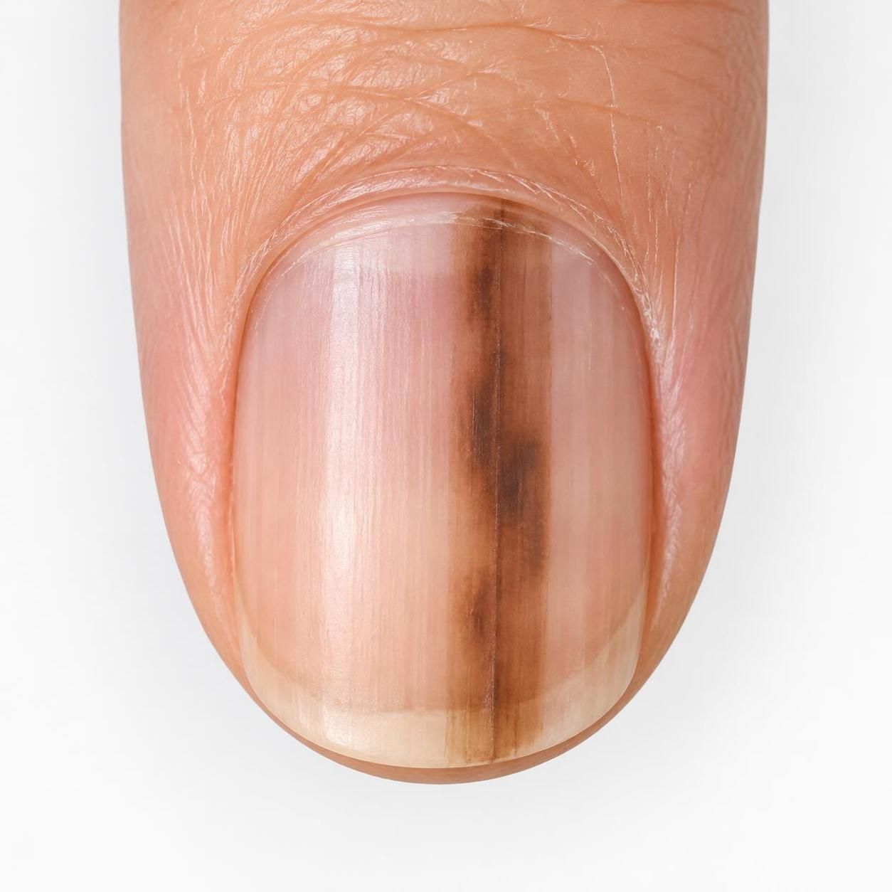 mélanome de l’ongle : repérez les signes d’alerte, comme une bande sombre ou une tache qui évolue, et consultez rapidement un professionnel de santé.